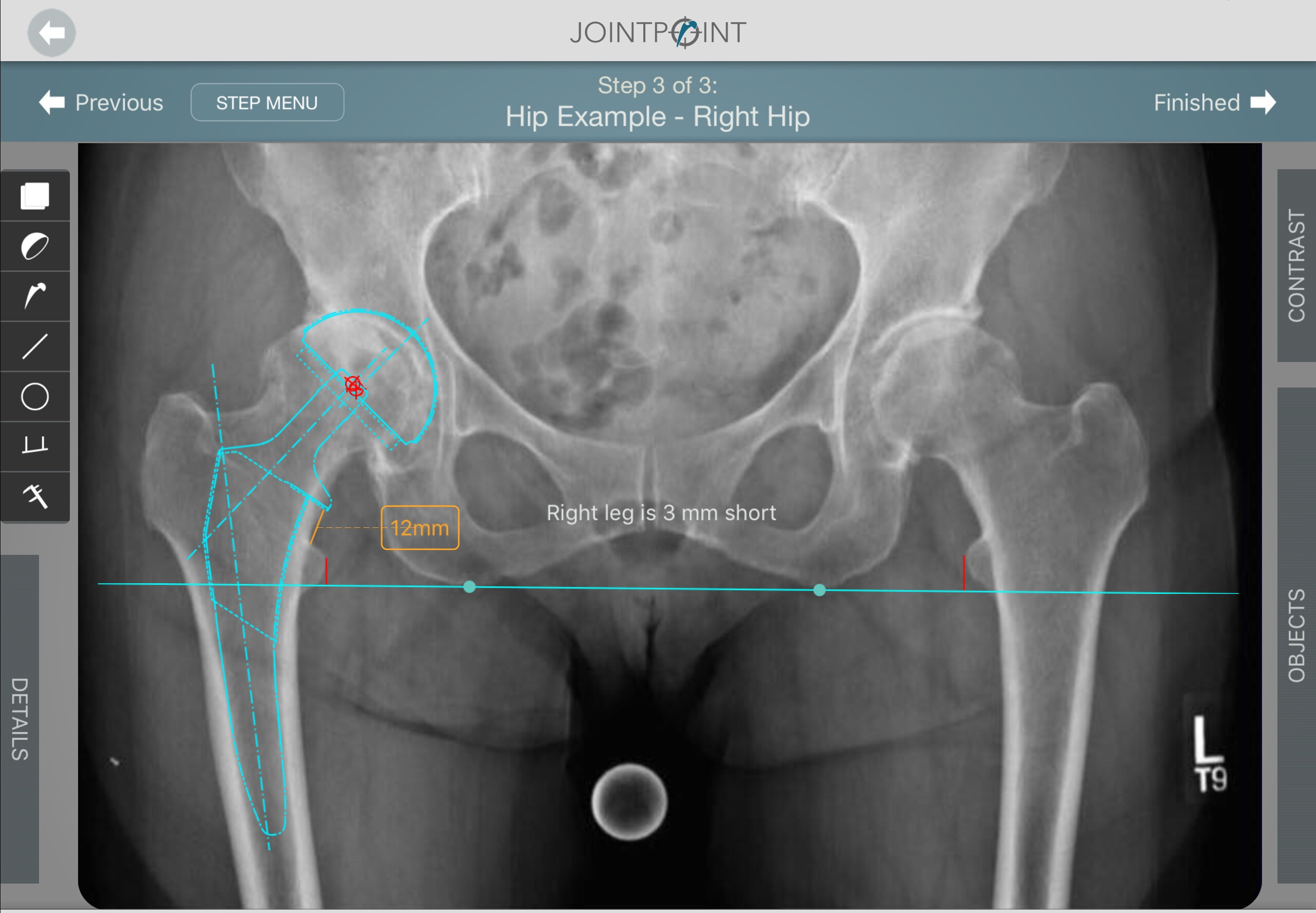 Hip Templating