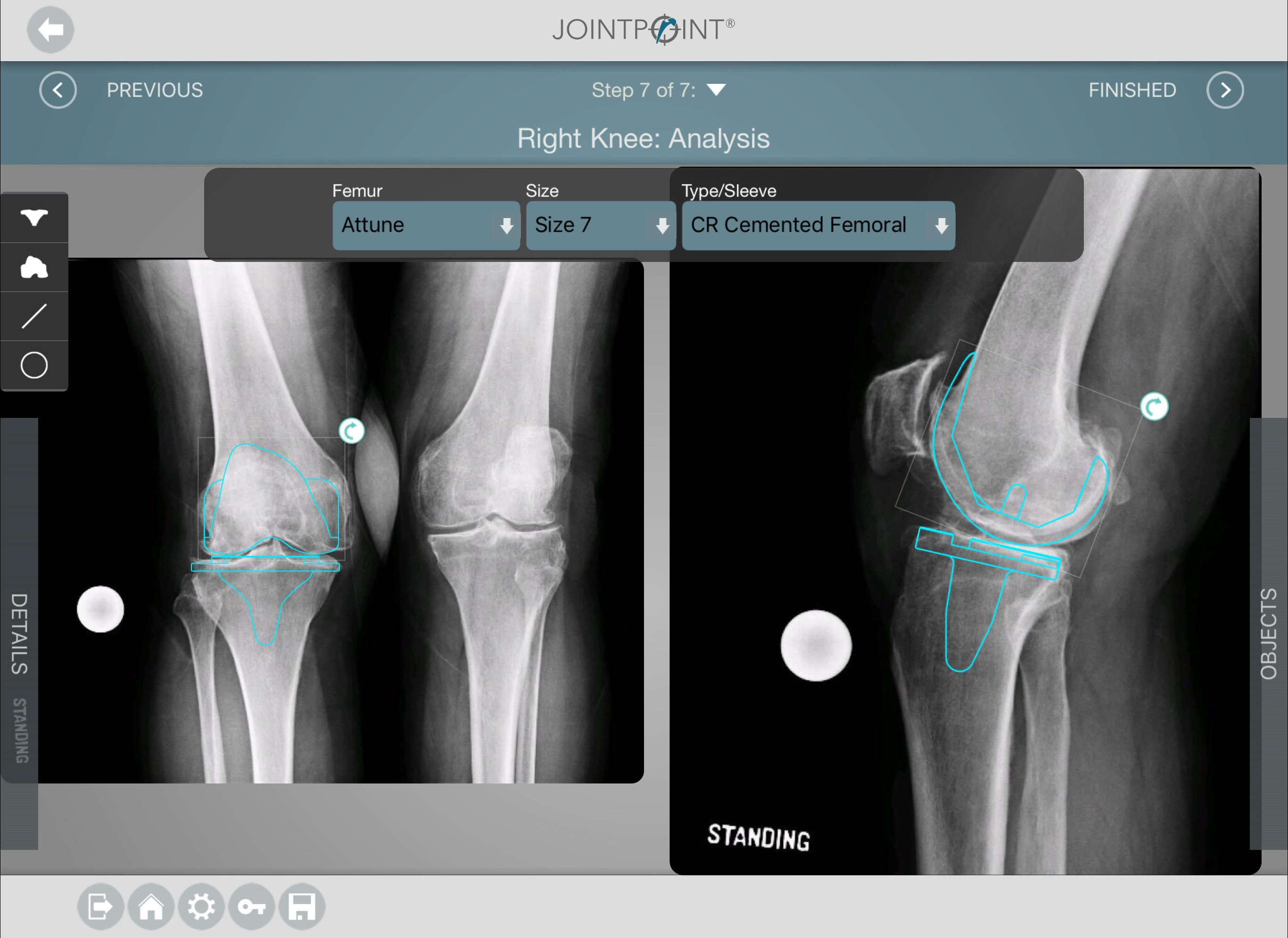 Knee Templating