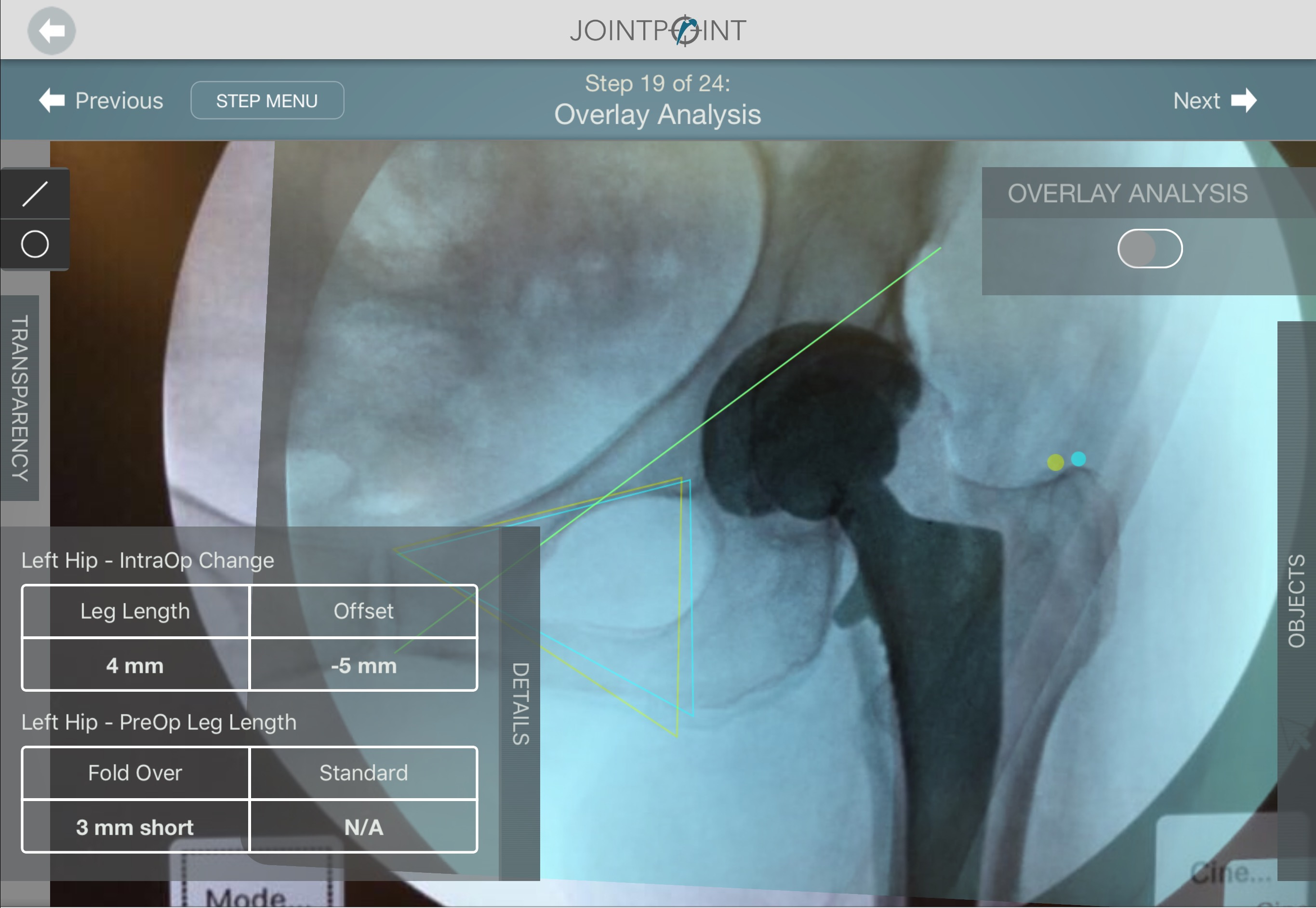 Intraoperative Offset & Leg Length Analysis